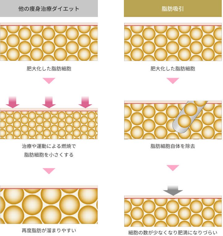他の痩身治療ダイエットと脂肪吸引の違い
